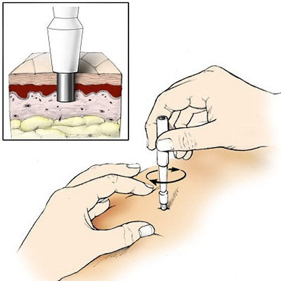 Sterilized Dermal Anchor Biopsy Punch